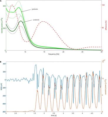 Changes in Interictal Pretreatment and Posttreatment EEG in Childhood Absence Epilepsy